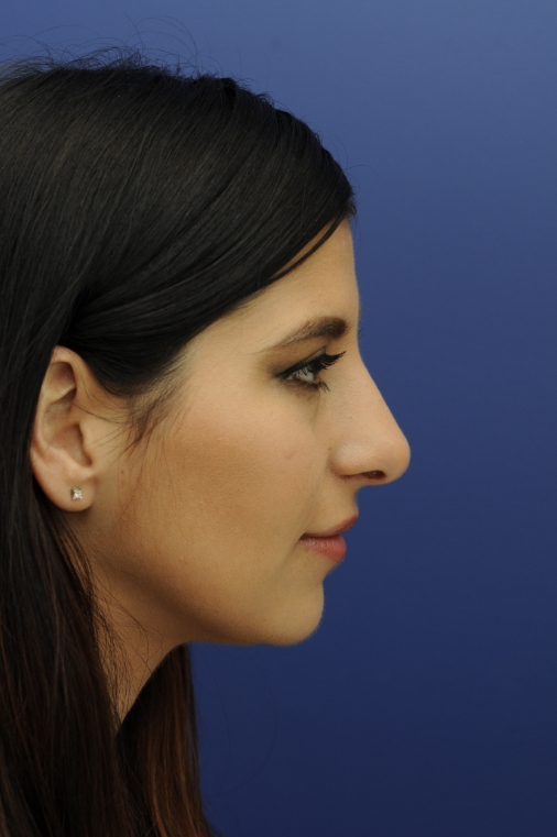 Female face, after Total Nose Approach treatment, r-side view