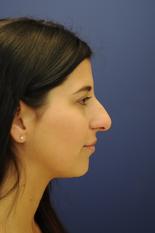 Female face, before Total Nose Approach treatment, r-side view