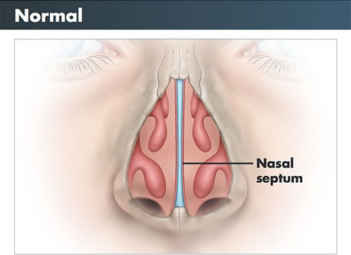 Normal (Nasal septum)