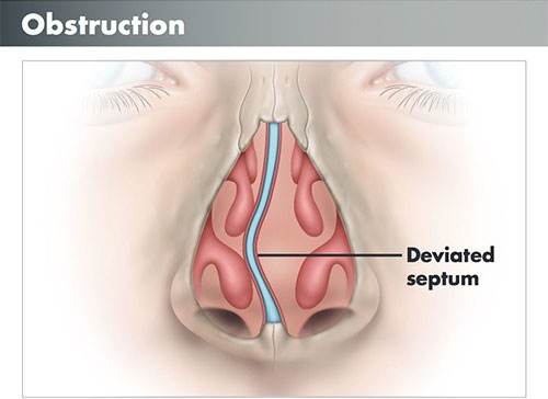 Obstruction (Deviated septum)