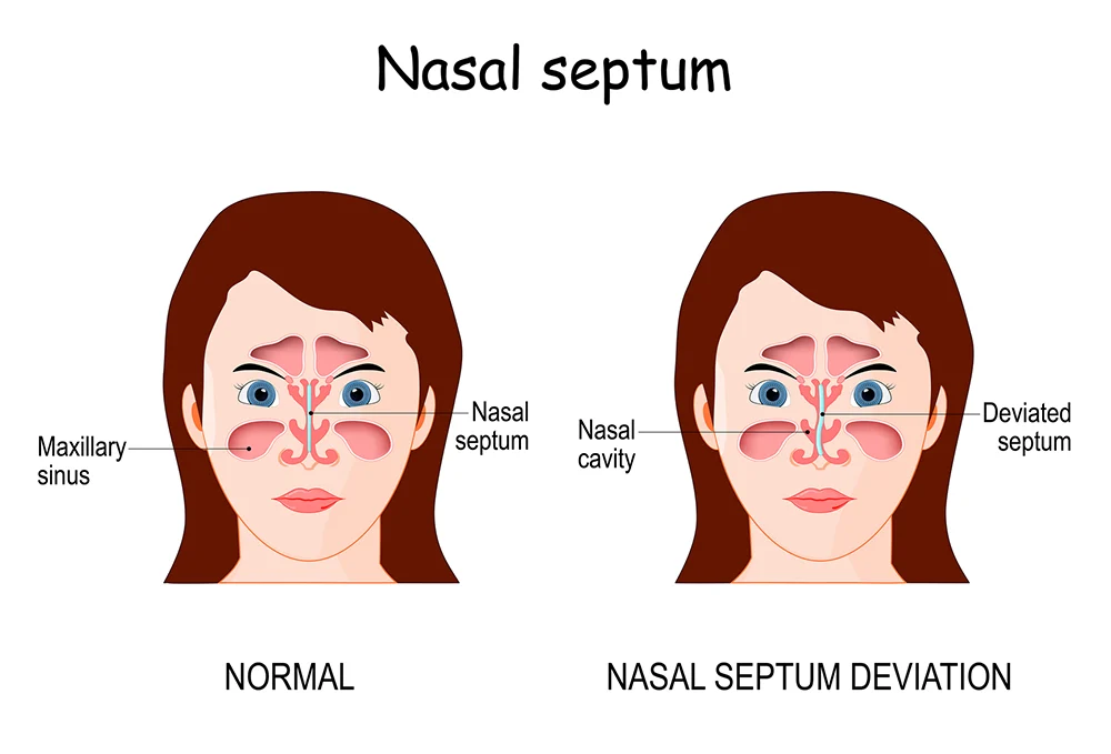 Nasal Septum Deviation Treatment | Boca Raton