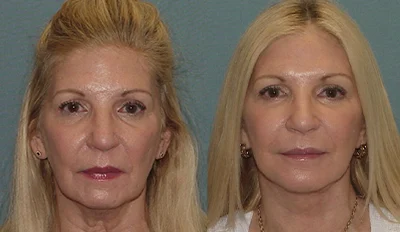 Facelift Real Patients