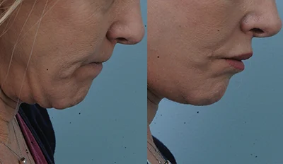 Neck Lift Real Patients