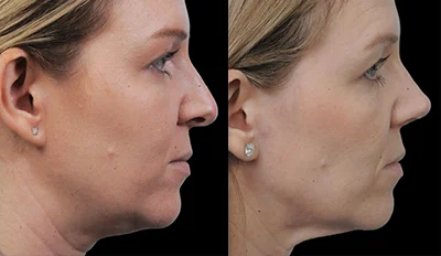 Rhinoplasty Real Patients